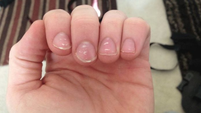 White Spots On Your Nails Doesn't Mean You Have A Calcium Deficiency